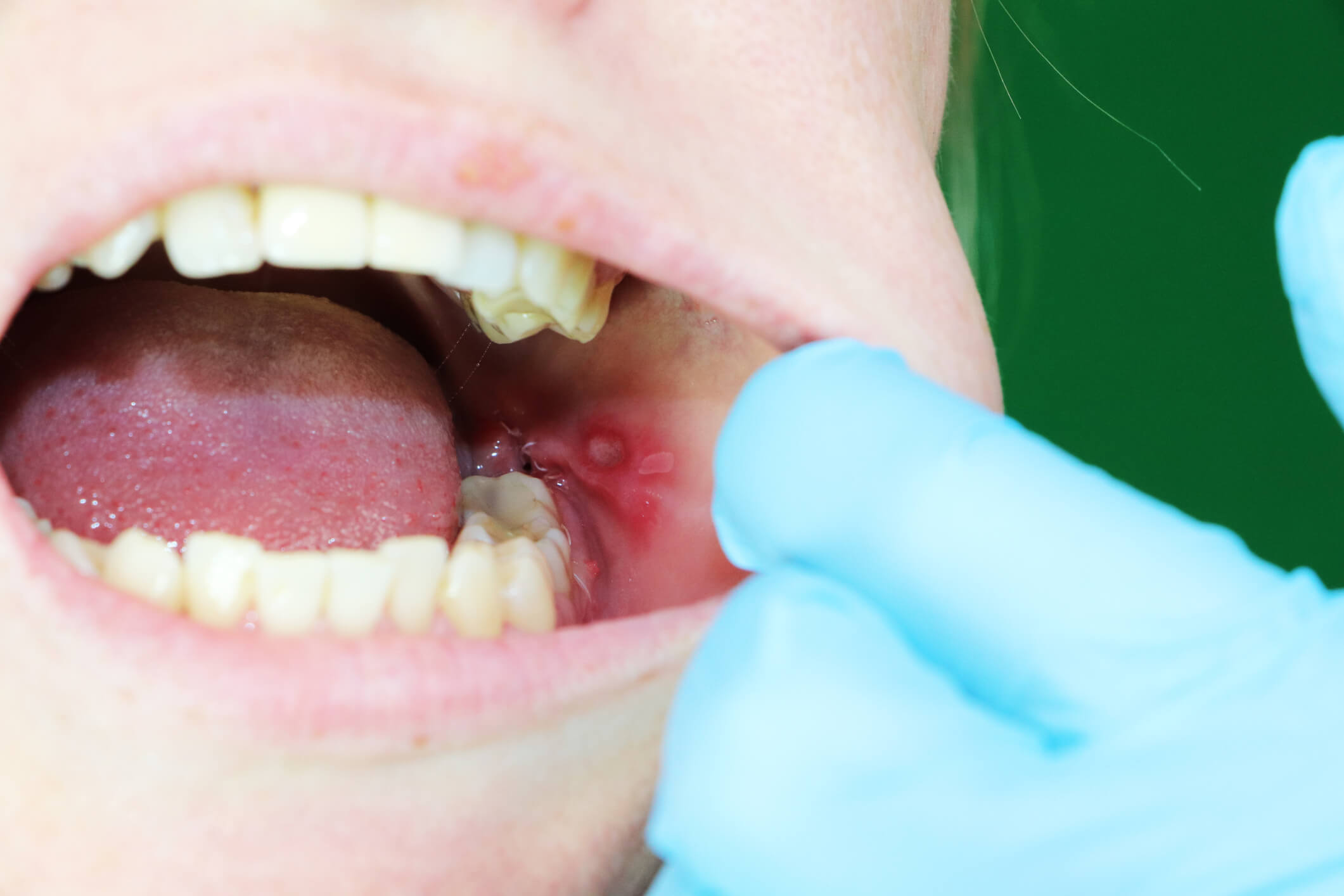 Lesões na boca que não cicatrizam podem ser sinais de câncer