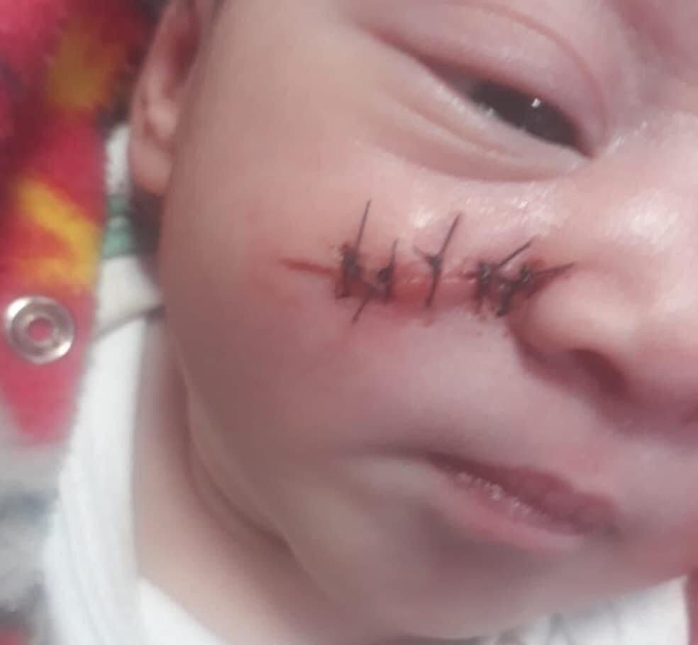 Bebê tem o rosto cortado durante Cesária no Hospital César Leite